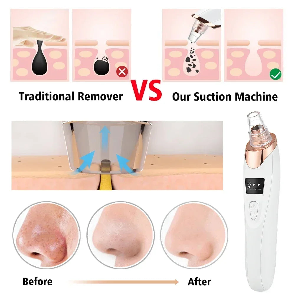 Electric Blackhead Remover with Vacuum Suction - USB Facial Pore Cleaner for Acne and Pimple Extraction